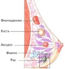 жлези мастопатия