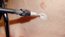 отстраняване интимни