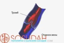 причини лечение