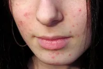 акнето лечение акне