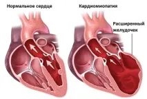 задавяне задавяне