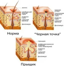 Вугри на обличчі причина та лікування препаратами запалення акне у чоловіків та жінок лікування