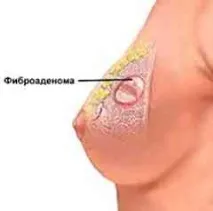 УЗІ молочних залоз при вагітності - Діагностика та профілактика - Каталог статей - Жіноче залоз