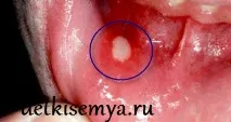 децата симптоми