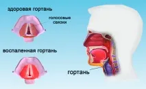 Симптоми ларингіту у дорослих – ознаки та прояви запалення гортані дорослих