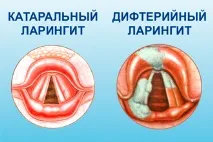 Симптоми ларингіту у дорослих – ознаки та прояви запалення гортані ларингіту
