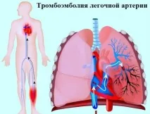 підколінної