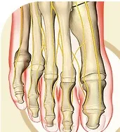 възможни Hallux valgus