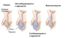 Водянка яєчка у дитини причини, наслідки, операція, видалення яєчка
