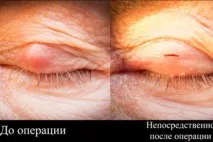 Халязіон верхньої повіки – причини, симптоми та лікування причини