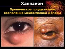 Халязіон верхньої повіки – причини, симптоми та лікування причини