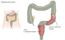 Виразковий коліт кишечника симптоми та лікування народними засобами коліт