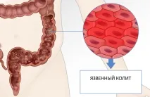 Виразковий коліт кишечника симптоми та лікування народними засобами кишечника