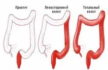 Виразковий коліт кишечника симптоми та лікування народними засобами лікування