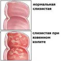 Виразковий коліт кишечника симптоми та лікування народними засобами симптоми