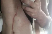 след ухапване отиде болницата