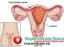 Вагітність після занесення міхура причини та лікування патології вагітність