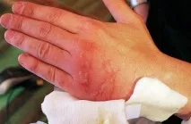 цинков оксид Бръщолевица Циндол