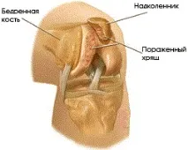 Біль у колінах – колінних суглобах при фізичних навантаженнях колінах