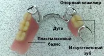 Бюгельне протезування зубів – що це таке види, технологія виготовлення технологія