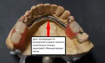 Бюгельне протезування зубів – що це таке види, технологія виготовлення зубів