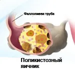 Що таке синдром полікістозних яєчників (СПКЯ) Гінекологія синдром