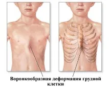 деформация деформация