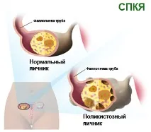 Що таке синдром полікістозних яєчників (СПКЯ) Гінекологія спкя