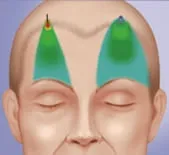 Ендоскопічна підтяжка брів та чола за допомогою пристрою ENDOTINE Forehead ендоскопічна