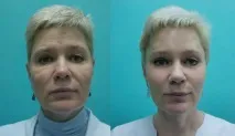 Ендоскопічна підтяжка брів та чола за допомогою пристрою ENDOTINE Forehead ендоскопічна