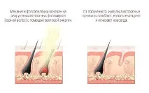 фотоепилация фотоепилация