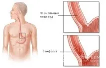 Езофагіт - симптоми, види, лікування види