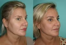 Ендоскопічна підтяжка брів та чола за допомогою пристрою ENDOTINE Forehead ендоскопічна