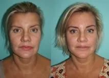 Ендоскопічна підтяжка брів та чола за допомогою пристрою ENDOTINE Forehead брів