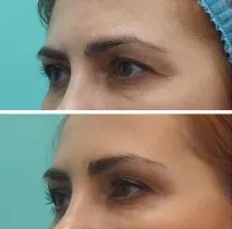 Ендоскопічна підтяжка брів та чола за допомогою пристрою ENDOTINE Forehead підтяжка