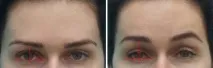Ендоскопічна підтяжка брів та чола за допомогою пристрою ENDOTINE Forehead брів