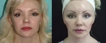 Ендоскопічна підтяжка брів та чола за допомогою пристрою ENDOTINE Forehead пристрою