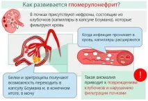 Гломерулонефрит у дітей причини, симптоми та лікування симптоми