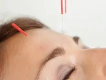 Очна акупунктура за методикою акупунктура