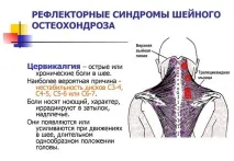остеохондроза лекува