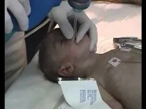 Стеноз гортані (звуження дихальних шляхів) що це таке, причини та лікування гортані