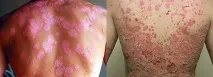 Стелара при псоріазі інструкція із застосування, відгуки, ціна псоріазі