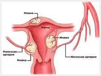 лечението миома