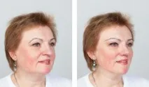 Ліфтинг брів кому він справді необхідний, як виконується ліфтинг