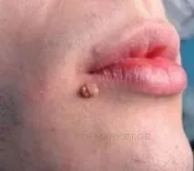 генитални брадавици