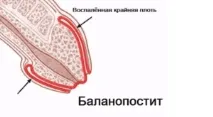 Медикаментозне лікування баланопоститу, препарати для лікування запалення головки статевого члена лікування