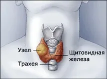 възли лечение