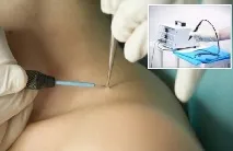 Сургітрон видалення папілом радіохвильовим методом радіохвильовим