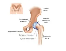Тазостегновий суглоб людини його докладна будова та можливі патології суглоб