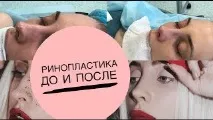 Відгук про ринопластику після